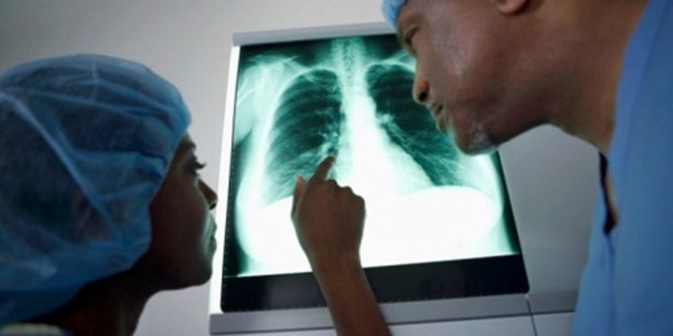 Sicilia. Autorizzato a Palermo un nuovo centro per la Fibrosi Polmonare Idiopatica