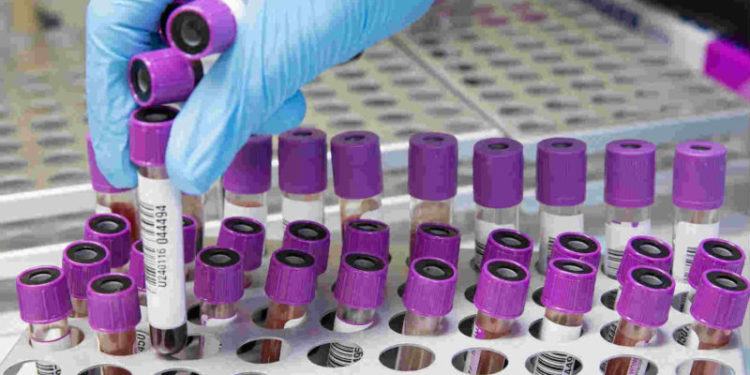 Coronavirus, Cafeo: “Razza autorizzi sperimentazione con plasma dei guariti”